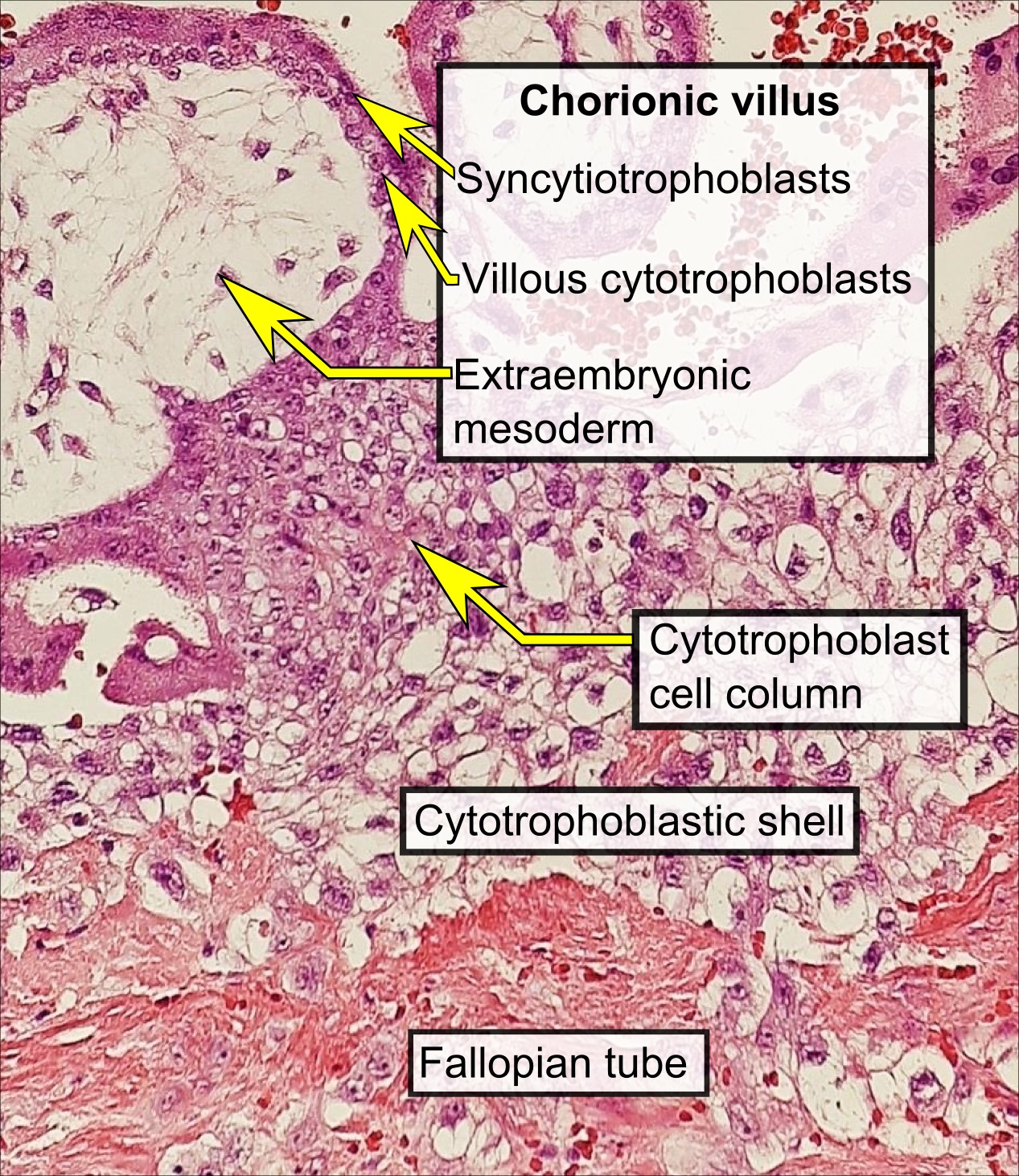 Histopathology of a chorionic villus, in a tubal pregnancy