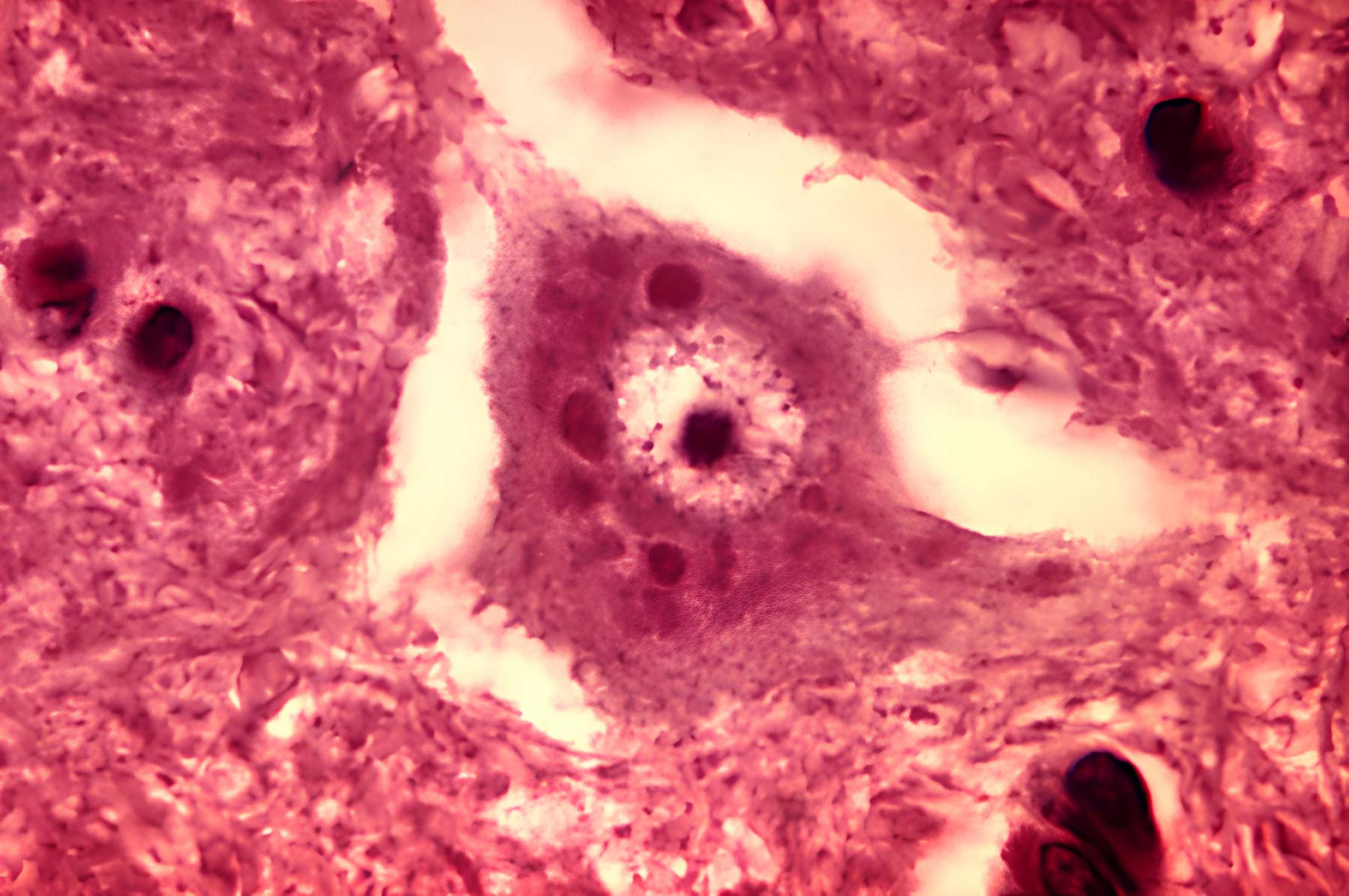 Histopathology of Negri bodies in rabies encephalitis Hydrophobia