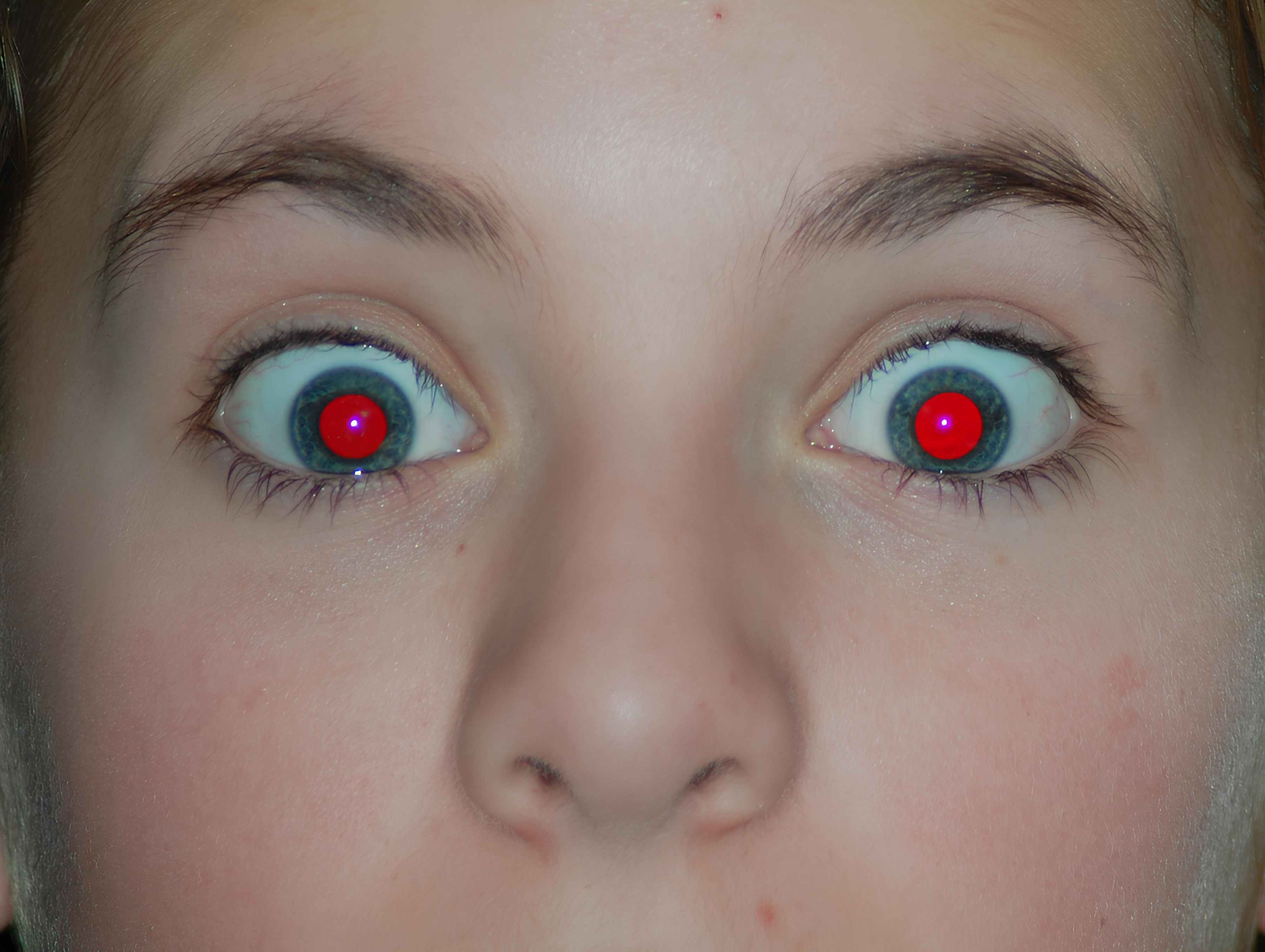 Intense red-eye effect in blue eyes with dilated pupil